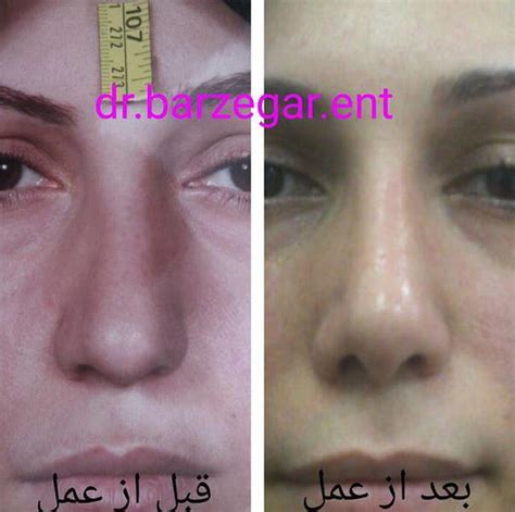 Before And After Deviated Septum (2) » Rhinoplasty: Cost, Pics, Reviews ...