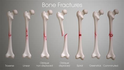 Fractures: Types, Symptoms, Causes and Treatment - Scientific Animations