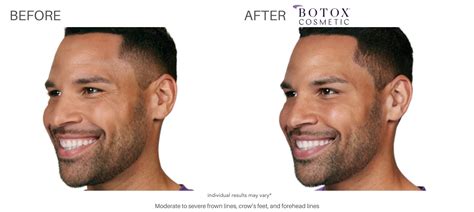 Botox Before and After | Real Results from Real Patients