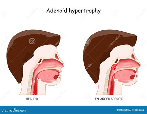 Adenoid Location. Lymphatic System Vector Illustration | CartoonDealer ...