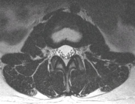 Axial Lumbar Anatomy