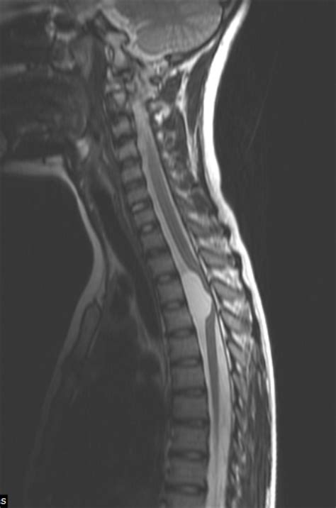 Spinal Intradural Arachnoid Cyst-MRI - Sumer's Radiology Blog