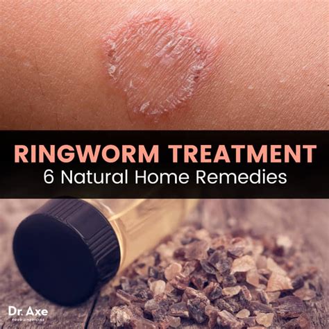 Ringworm Treatment: Try These 6 Natural Remedies - Dr. Axe