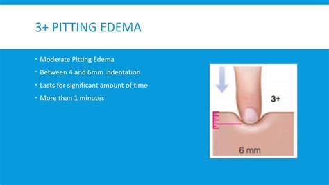 Pitting Edema Levels