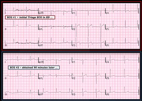 Dr. Smith's ECG Blog: Dynamic, Reversible, Ischemic T-wave inversion ...