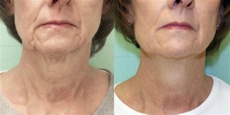 Radio Frequency Skin Tightening [Complete Guide] - Skin Care Geeks