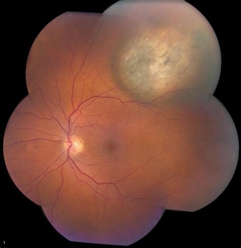 Choroidal Nevus - Retina Image Bank