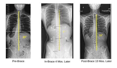 Scoliosis Before And After