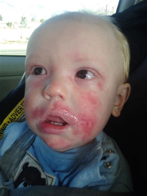 Adams Family: Severe Allergy Induced Eczema On My Infant.