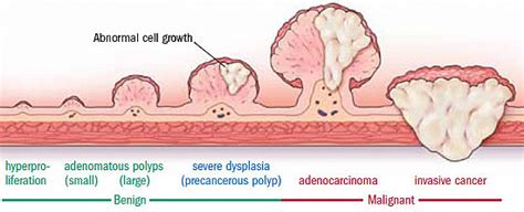 They found colon polyps: Now what? - Harvard Health