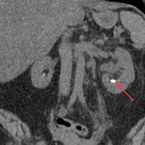 Why Do Kidney Stones Cause Pain? | Kidney Stone Evaluation And Treatment Program