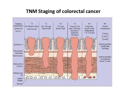 Colorectal Cancer Stages