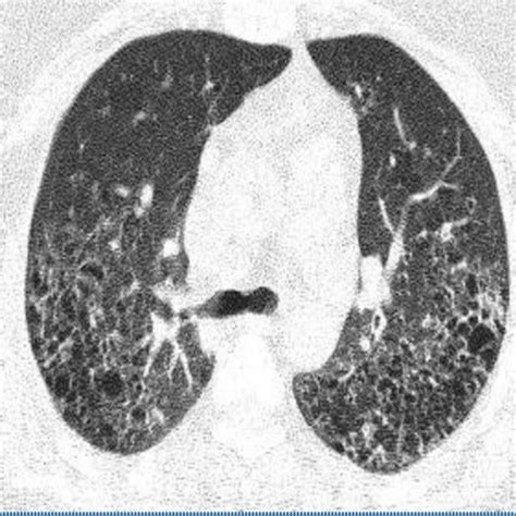 PET-scan for differential diagnosis of lymphoma reveals increased... | Download Scientific Diagram