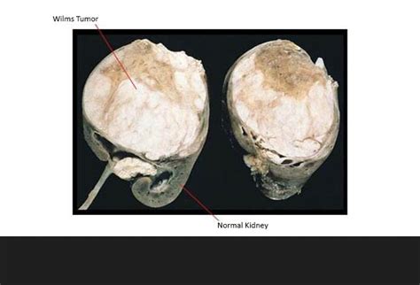 Wilms Tumor: A Pediatric Oncology Success Story