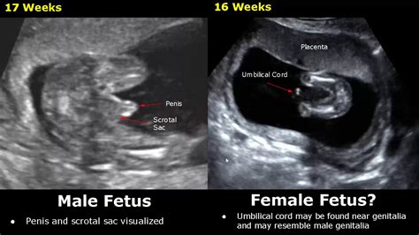 Fetal Gender Determination On Ultrasound | Determining The Sex Of A Baby On USG (Boy/Girl ...