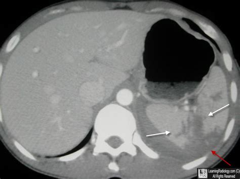 LearningRadiology - Splenic Laceration