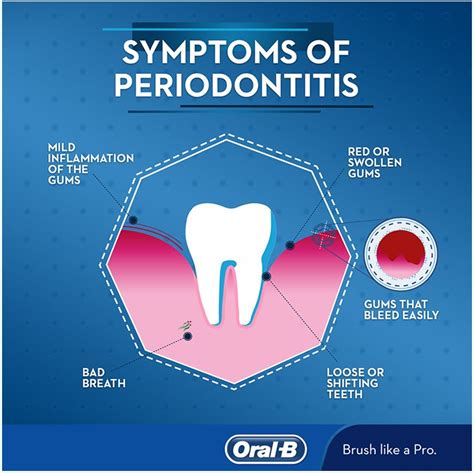 What is Periodontitis? Treatments, Signs, and Symptoms - Oral-B