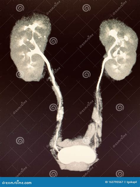 Modern Ct Urogram With Contrast Function Kidneyes Stock Image - Image of medical, excretory ...