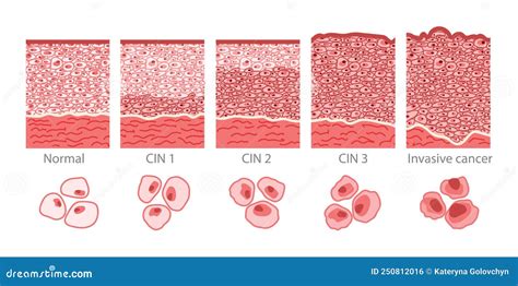 Cervical Cancer Cells Elongated Dysplasia Stages Infographic Female ...