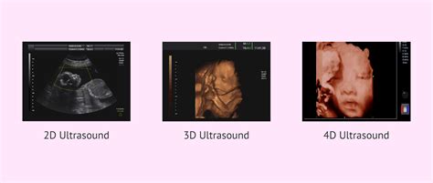 Differences in imaging between 2D, 3D and 4D ultrasound