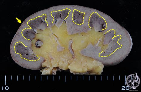 12.Kidney and Urinary System (12) Acute tubular necrosis|Pathology Core Pictures