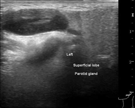 Swollen Parotid Lymph Node