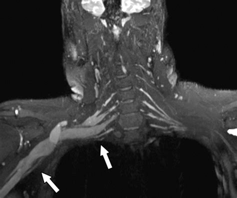 Brachial Plexus Injury Mri