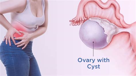 Ovarian Cyst Removal Surgery in India Causes, Hospitals