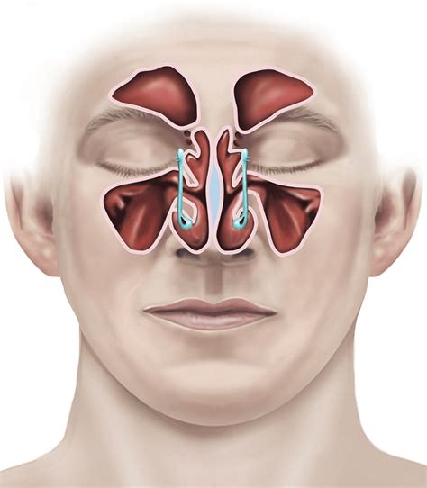 Endoscopic sinus surgery | healthdirect