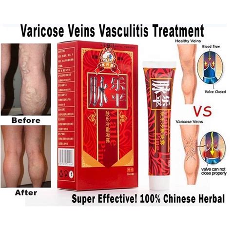 Varicose Veins Treatment Cream Ointment Vasculitis Phlebitis Spider Herbal Cream rawat urat ...