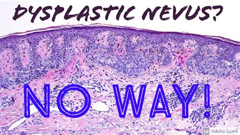 Dysplastic Nevus Histology