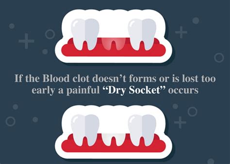 Dry Socket: Causes, Symptoms, Treatment, and Prevention