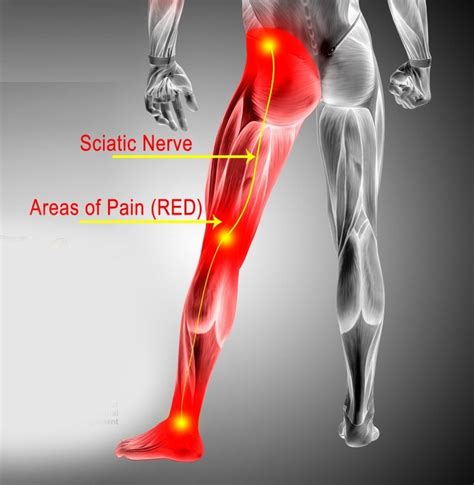 Sciatica Hip Pain Causes, Treatment Los Angeles, Beverly Hills, Santa ...