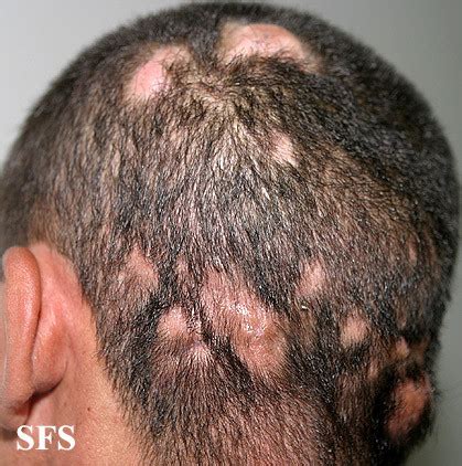 Tinea Capitis (Scalp Ringworm, Hair Fungal Infection) Pictures | Healthhype.com