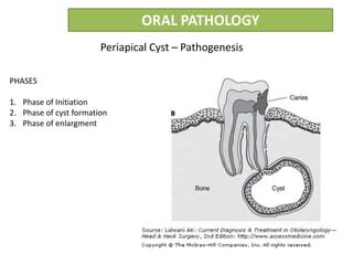 Radicular cyst or Periapical cyst | PPT