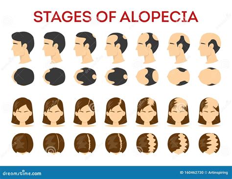 Alopecia Stages Set. Hair Loss, Balding Process Stock Vector - Illustration of hairstyle, head ...