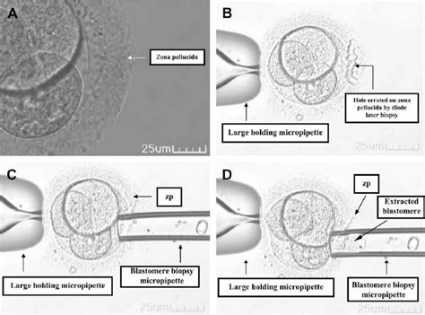 Blastomere biopsy procedure. (A) Unwanted embryo at six-cell stage is ...