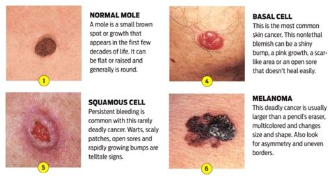 Skin Cancer: The Signs You Should Watch Out For | SpaMedica