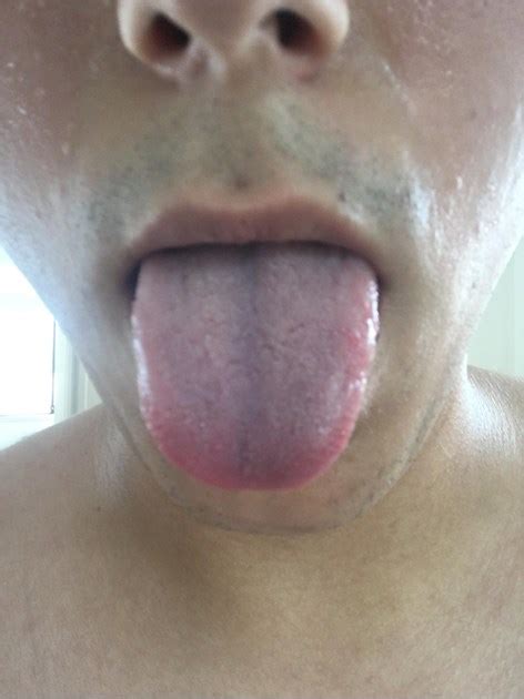 My blue tongue during/straight after ... - Lung Conditions C...