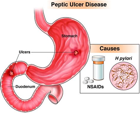 Small Intestine Ulcer Treatment