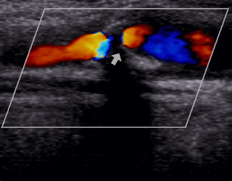 Abnormal Carotid Doppler Ultrasound