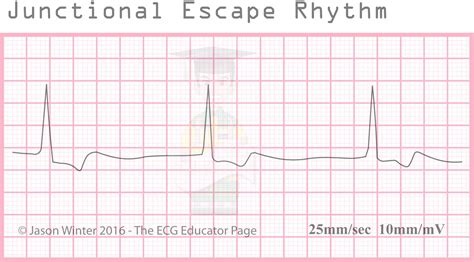 ECG Educator Blog : Junctional Rhythms