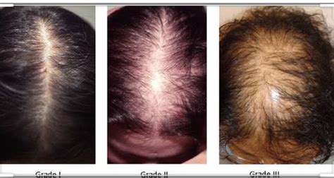 That common cause of hair loss -androgenetic alopecia – Skinandall