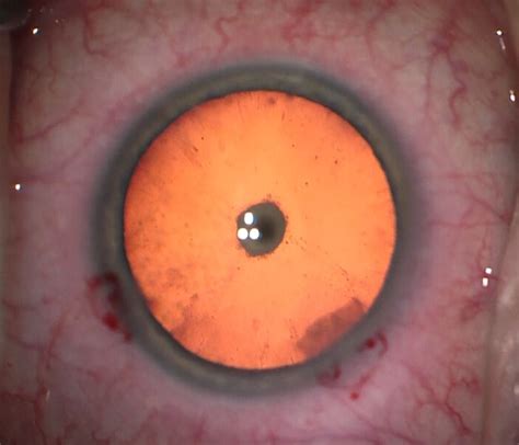 Posterior Subcapsular Cataract: Signs, Causes and Treatment