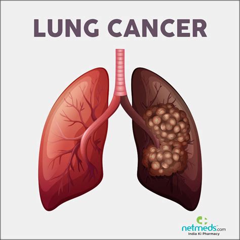 Warning Signs Of Lung Cancer