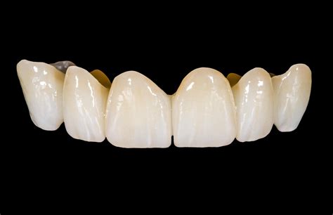 What is a Zirconia Crown? - Arc Dental