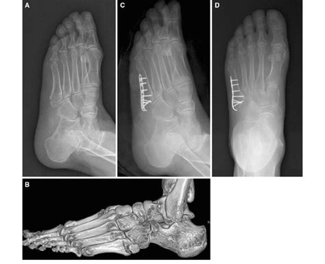 A 64-year-old woman with a fifth metatarsal base fracture. a... | Download Scientific Diagram