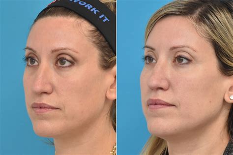 Injectable Fillers photos | Philadelphia, PA | Patient 1569