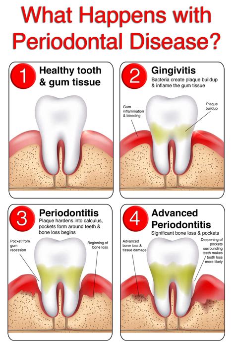 Teeth Falling Out Due To Gum Disease - Teeth Poster