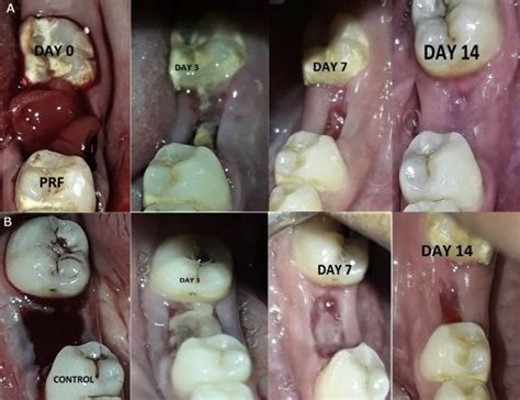 Day by Day Tooth Extraction Healing Stages with Pictures 2023 - Go Fix Teeth